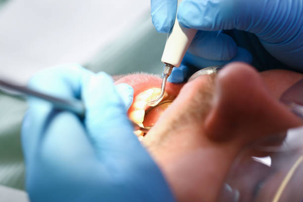 Best Emergency Dental Care for Broken or Chipped Teeth in Walnut Creek, CA
