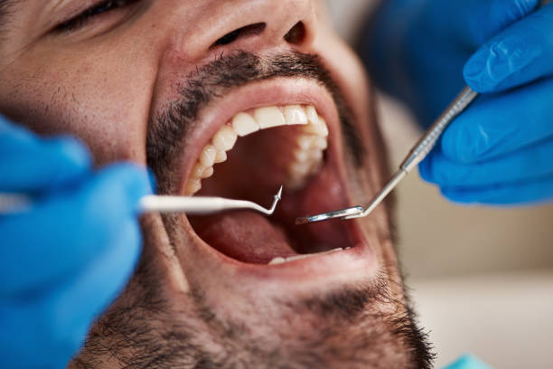 Best Emergency Wisdom Teeth Removal in Walnut Creek, CA